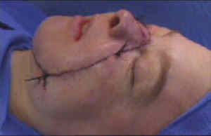 Isabelle after the Operation
